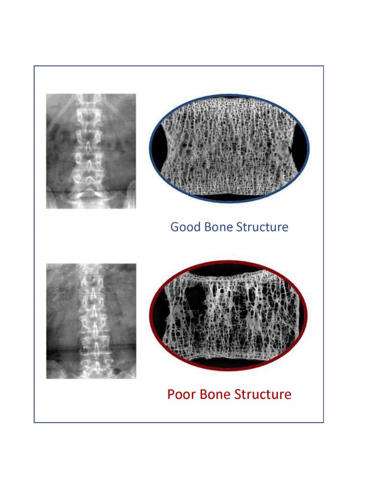 Trabecular Bone Score (TBS)standard bone density testing